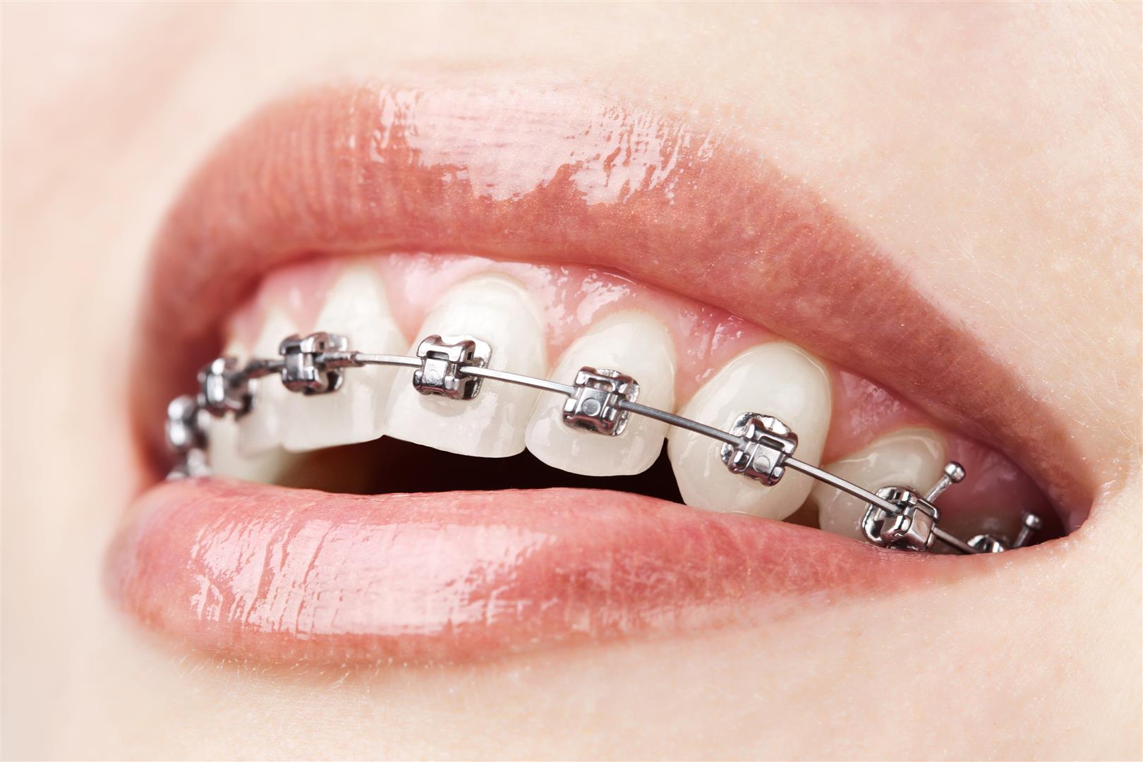 Orthodontie - Consultation
